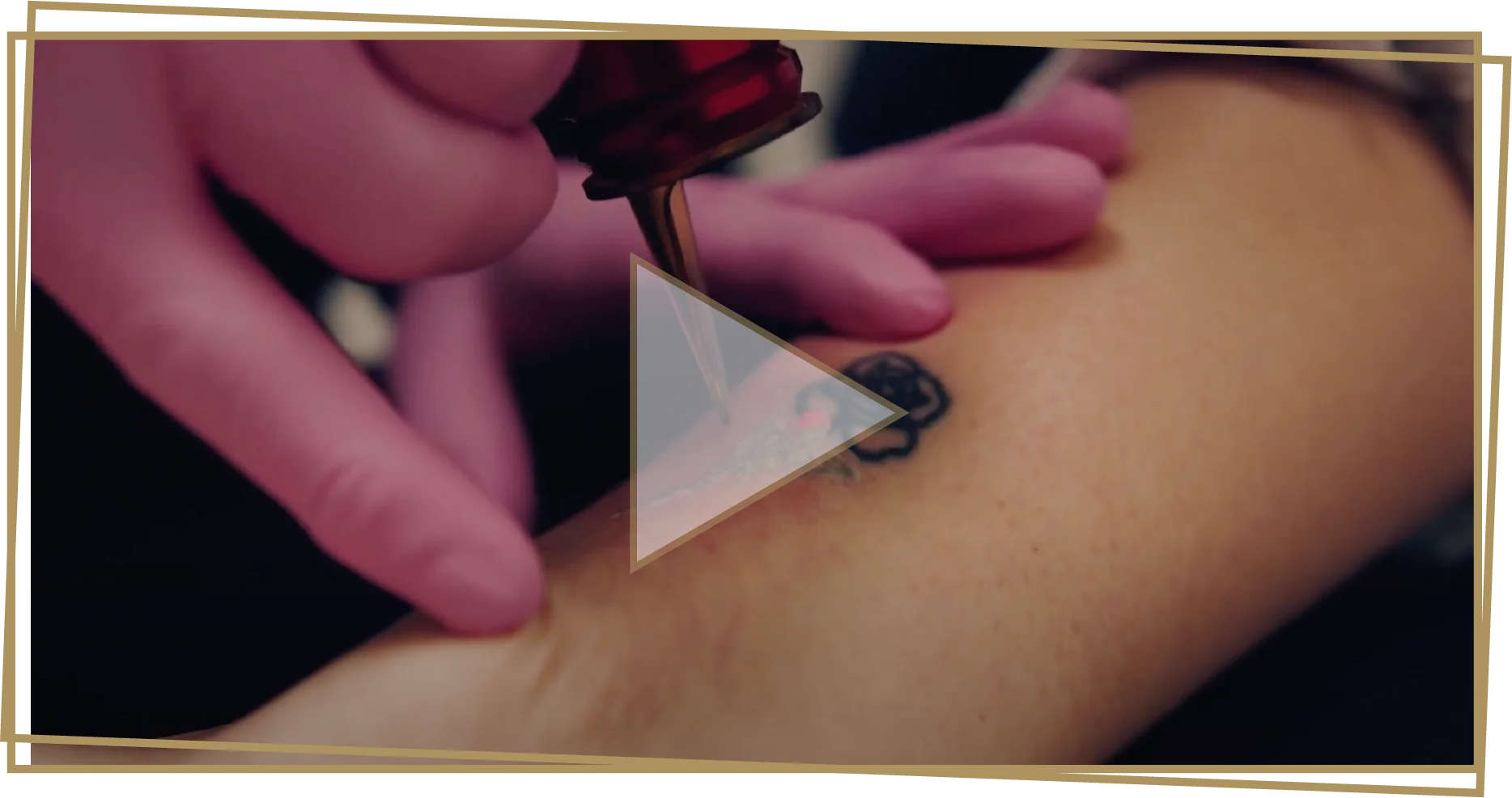 Laser Tattoo Removal Video