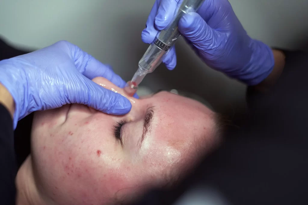 Microneedling nose post treatment