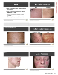 acne examples workbook page
